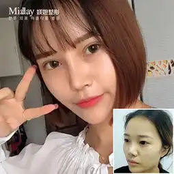  切开双眼皮切开双眼皮耀眼术仿生态斩男桃花眼萌系少女元气眼芭比电眼max闭眼隐痕悦美整形